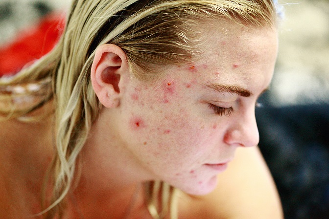 all-acne-breakouts-are-created-equal